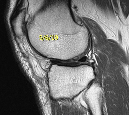 Figure 4 for case Button osteophyte filling chondral defect